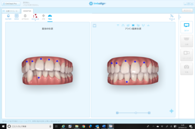 iTero elementのInvisalign Outcome Simulatorという機能について