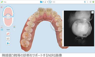 口腔内スキャナーiTero element 5Dの新しい機能･･近赤外線画像(NIRI画像)