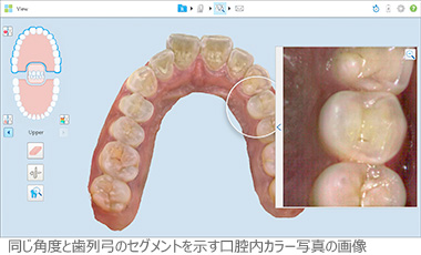 口腔内スキャナーiTero element 5Dの新しい機能･･近赤外線画像(NIRI画像)