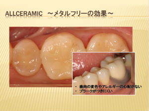 詰め物にコンポジットレジンを使うか、セラミックを使うか？その賢い選び方。
