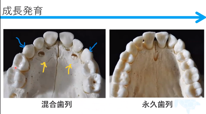 どうして矯正治療をするの？小児編