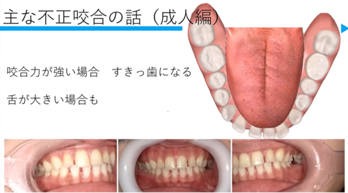 どんな歯列不正があるの？
