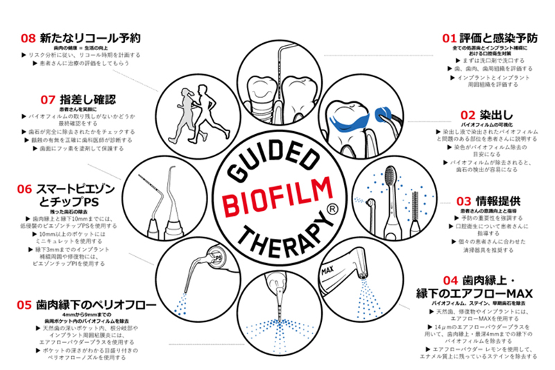歯に優しい治療・予防法「GBT」